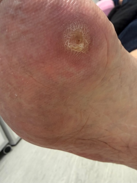 Callus / Corn